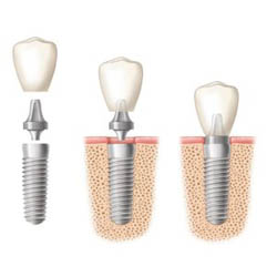 Photos of DENTAL IMPLANT PROFESSIONALS Sydney